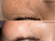 レイル(REIR)/肌質改善プログラム（レベル3）