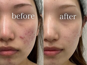 ルテア(Retea.)/【赤み】ハーブピーリング