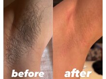 ウネ 吉祥寺(une)/脇もその日に綺麗が叶います！