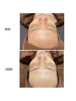 ヴィヴィエ 佐賀店(ViVier)/ララピール症例3回