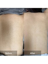 モカ 天王寺店(MOKA)/背中剥離 4回目