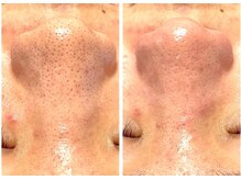 香嬉琉/毛穴洗浄［黒ずみ］before&after