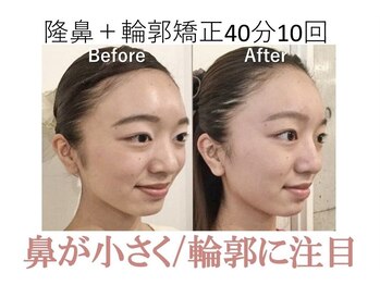 ラプリ 梅田店(Raplit)/隆鼻＋輪郭矯正40分10回