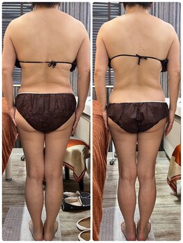 レヴィ(Revie)/60代ウルトラ造形リンパ1回