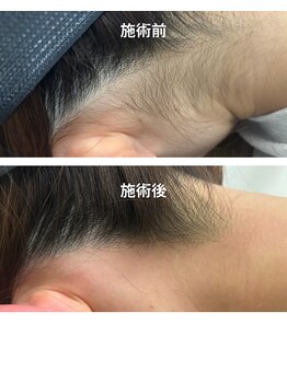 ジェンティル(Gentil)/ワックスでうなじ脱毛に自信あり