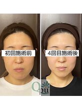 キュープ 鹿児島伊集院店(Qpu)&nbsp;小顔矯正 美顔器