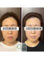 キュープ 鹿児島伊集院店(Qpu) 小顔矯正 美顔器
