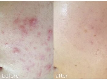 【シミ・ニキビ・毛穴専門店】Bell skin/ニキビ肌改善