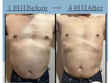 フェアリー/ボディデトックス痩身　1部位