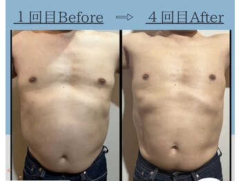 フェアリー/ボディデトックス痩身 1部位