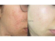 プランス 渋谷(PLANCE)/韓国/肌管理/ニキビケア/毛穴