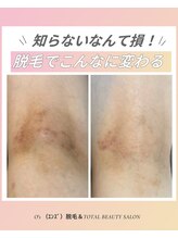 エンズ(O's)/生まれ変わるお肌♪