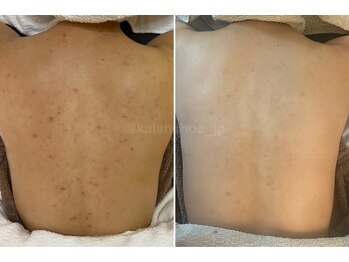 カランコエ(KALANCHOE)/お背中の気になるケアにも◎