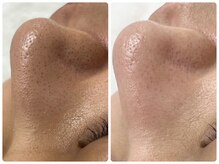 シアンビビ(Cyaan bibi)/韓国式３D毛穴洗浄