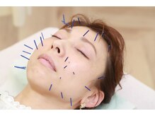 エムアンドエス鍼灸整骨院(M&S鍼灸整骨院)/美顔鍼