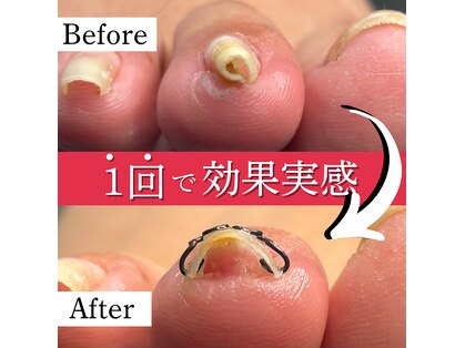 巻き爪矯正センター 沖縄 宜野湾の写真