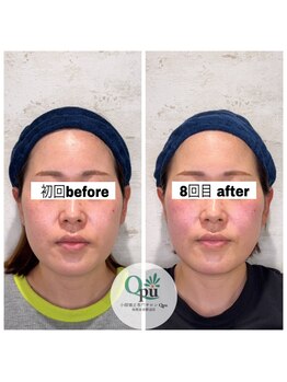 キュープ 相模原淵野辺店(Qpu)/たった4回で人生で1番小さな顔に