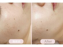 エピル(EPIL)/ララピール症例