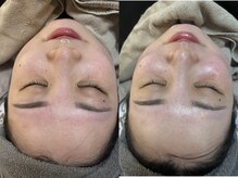 ビーマジック(Be Magic)/水分量UP！毛穴洗浄！