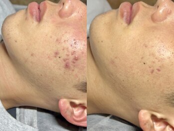 エモーショナル 姫路(Emotional)/ハーブピーリングで肌荒れケア