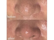 ザ シー(the she)の雰囲気(二刀流毛穴エクストラクション(一回の施術です))