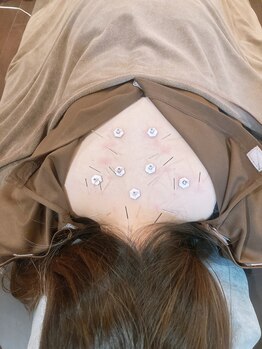 アキュティ 吉祥寺(Acuty)/上半身鍼施術