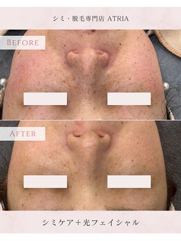 アトリア(ATRIA)/ホワイトシミケ×光フェイシャル