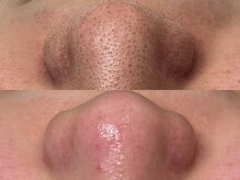 スリーナイン ビュウ(3Nine BEAU)/2回目before/after