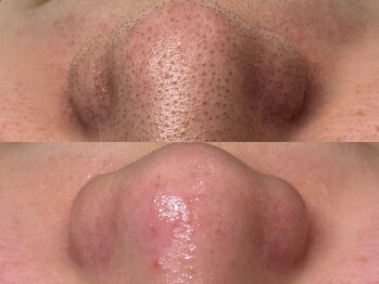 スリーナイン ビュウ(3Nine BEAU)/2回目before/after