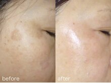 【シミ・ニキビ・毛穴専門店】Bell skin/Dr.purBEAUTE正規取扱店