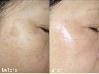 【シミ・ニキビ・毛穴専門店】Bell skin/Dr.purBEAUTE正規取扱店