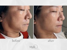 メルト 中目黒(Melt.)/◇サーマジェン