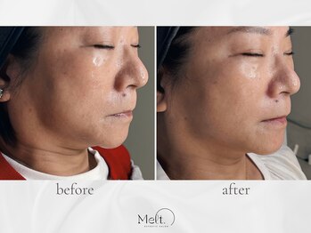 メルト 中目黒(Melt.)/◇サーマジェン