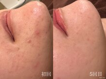 ウォーム(warm)/肌質改善/岡山/フェイシャル