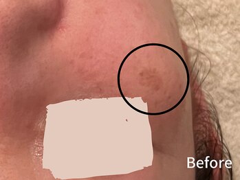 ダイヤモンド リーエンダ(Diamond leende)/クレイハーブピーリング