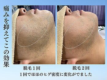 アンジェリーナ/痛みの少ないヒゲ脱毛