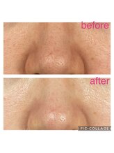 カレン(Current)/毛穴ケア♪肌質改善ピーリング