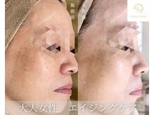 煌/ケースタイル(K-style)/ハーブピーリング　顔　一宮市