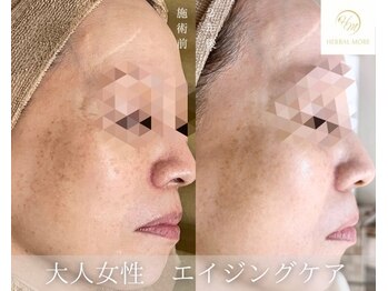 煌/ケースタイル(K-style)/ハーブピーリング 顔 一宮市