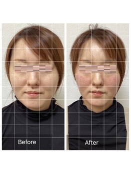 小顔整体 優/1回でわかる！究極の小顔へ☆