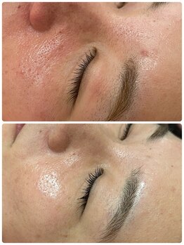 クラティス 伊那店(CRATIS)/レチノールで毛穴レス