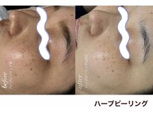 スマイル(SMILE)の雰囲気(毛穴洗浄×ハーブピーリング×脱毛まとめて美肌ケアができます。)