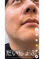 ハーバリー ハーブピーリング 栄(HERBERRYハーブピーリング)&nbsp;全国9店舗展開中！ハーブピーリング専門店HERBERRY