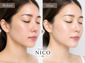 ニコ(NICO)の写真/【夏の紫外線ダメージ、秋のうちにリセットケア☆】韓国肌管理「ララピール」