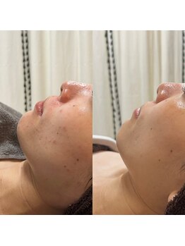 サロンノワ(salon noix)の写真/【島根・松江】ニキビ・毛穴の開きはお任せ！低刺激スピキュールで叶える、肌質改善＊