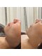 サロンノワ(salon noix)の写真/【島根・松江】ニキビ・毛穴の開きはお任せ！低刺激スピキュールで叶える、肌質改善＊