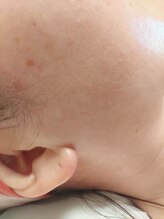 キアラ 麻布十番(Kiara)/もみあげ脱毛