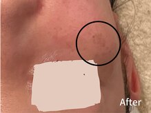 ダイヤモンド リーエンダ(Diamond leende)/クレイハーブピーリング