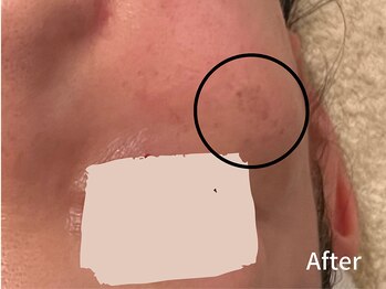 ダイヤモンド リーエンダ(Diamond leende)/クレイハーブピーリング