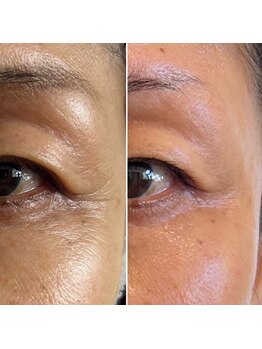 RKボディアンドフェイシャルサロン(RK body&facial salon)/セルラム4回目の方の変化